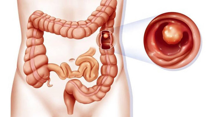 Ung thư đại tràng cũng là một kẻ giết người thầm lặng phổ biến. Dấu hiệu thường là sự xuất hiện của một khối u nhỏ ở trực tràng hoặc đại tràng. Nó được gọi là polyp. Hầu hết các polyp này đều không phải ung thư, nhưng khi bỏ qua hoặc không được điều trị, một số trong số đó có thể biến thành ung thư sau một vài năm.