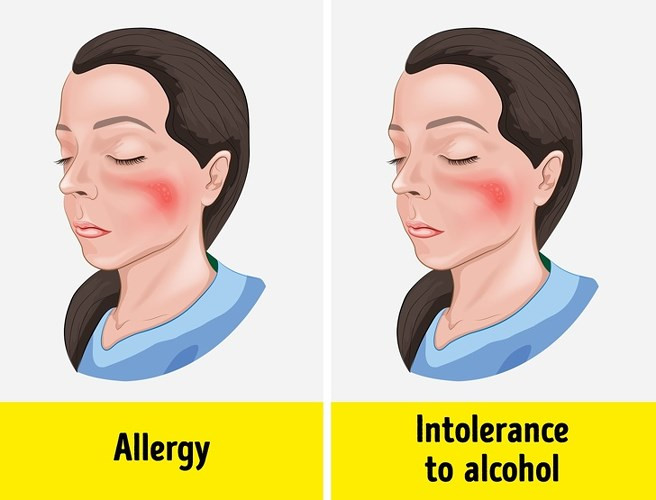 Da mẩn đỏ là dấu hiệu phổ biến nhất khi không dung nạp rượu. Một số người thậm chí có mụn nước nhỏ trông giống như phát ban, đó là lý do tại sao nó thường bị nhầm lẫn với một phản ứng dị ứng. Đầu tiên, những đốm nhỏ xuất hiện trên mặt và sau đó lan ra khắp cơ thể.
