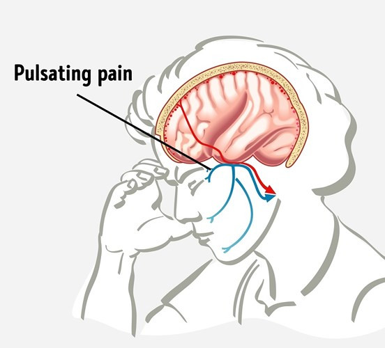 Chứng đau nửa đầu sẽ xảy ra nếu bạn uống quá nhiều. Trong trường hợp này, chứng đau nửa đầu bắt nguồn từ sự giải phóng histamine.