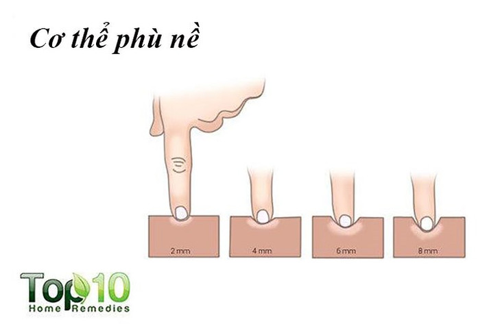 Phù nề: Muối có thể làm cho thận giữ lại chất lỏng, dẫn đến việc giữ nước hoặc phù nề. Sự lưu giữ này xảy ra bởi vì thận cảm nhận rằng cơ thể cần nhiều chất lỏng hơn để bù đắp cho sự giảm lưu lượng máu. Ngoài ra, mức tiêu thụ natri cao có thể dẫn đến sự mất cân bằng điện giải, một nguyên nhân khác của phù nề.