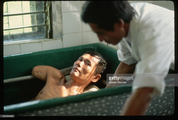 Một cựu chiến binh cụt tay được điều dưỡng chăm sóc tại một trung tâm thương binh ở ngoại thành Hà Nội, 3/8/1993.