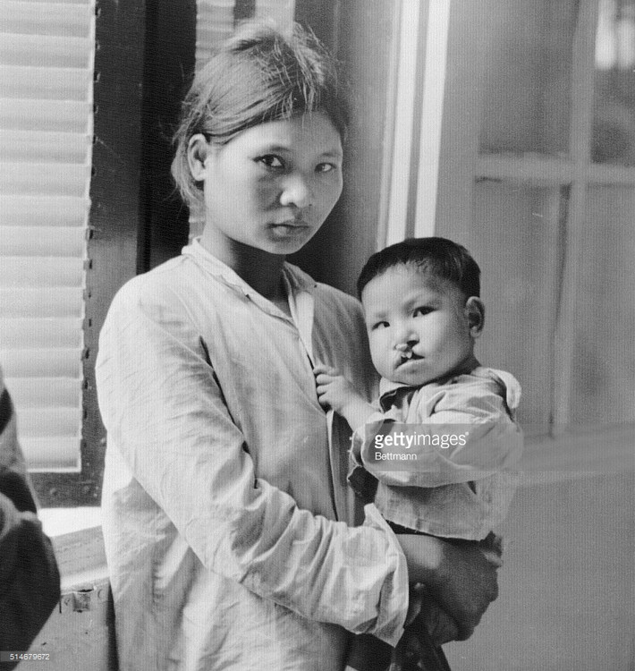 Người mẹ bế đứa con bị hở hàm ếch do di chứng chất độc da cam tại một bệnh viện ở Hà Nội năm 1980. Ảnh: Getty Images.