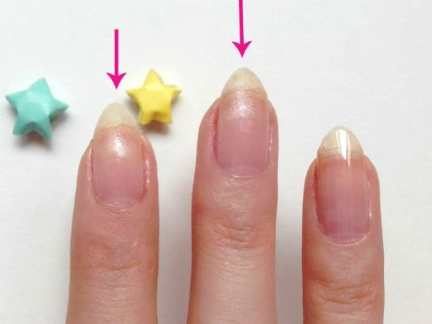 Đây là 3 ngón tay với 2 ngón đầu tiên đã bị gãy rồi vá lại, Sự khác biệt rất khó nhận ra.