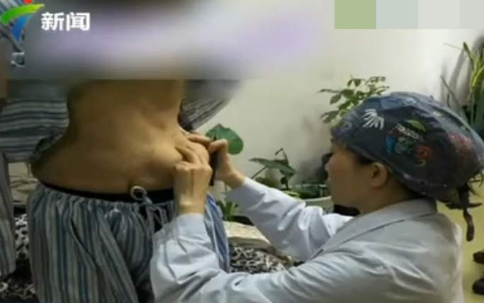 Một phụ nữ Trung Quốc vô tình mọc núi đôi ở trên bụng sau khi tự tiêm một loại gel làm đầy để tăng kích cỡ vòng 2. Trái với kỳ vọng của cô, vòng 2 không những không to hơn mà còn bắt đầu bé đi. Tệ hơn nữa khi cô bỗng thấy vùng bụng của mình nổi lên 2 cục u. Khi kiểm tra, các bác sĩ mới tá hỏa khi biết đó chính là chất gel mà cô đã bơm vào ngực nhưng nay đã chảy dần xuống bụng. (Ảnh: Metro)