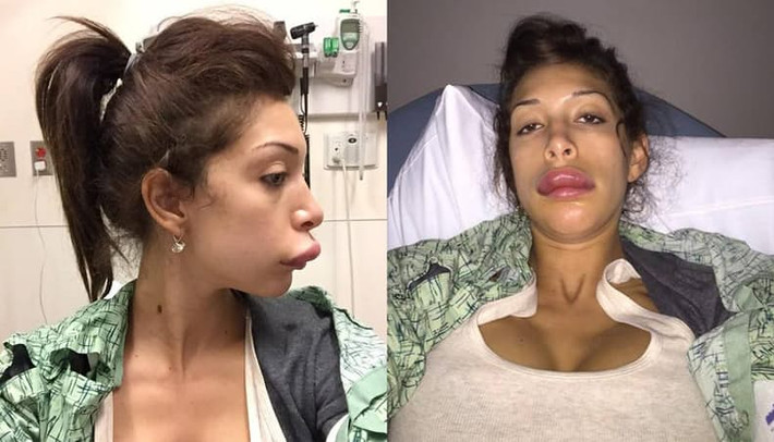 Nhờ có Kylie Jenner mà môi dày đã trở thành mốt. Tuy nhiên, đối với Farrah Abraham thì quá trình thẩm mỹ môi đã trở thành một cơn ác mộng. Abraham bị dị ứng với chất bơm môi nhưng bác sĩ quên không thử. Hậu quả mà môi trên của cô đã sưng phồng lên khủng khiếp. (Ảnh: Talko)