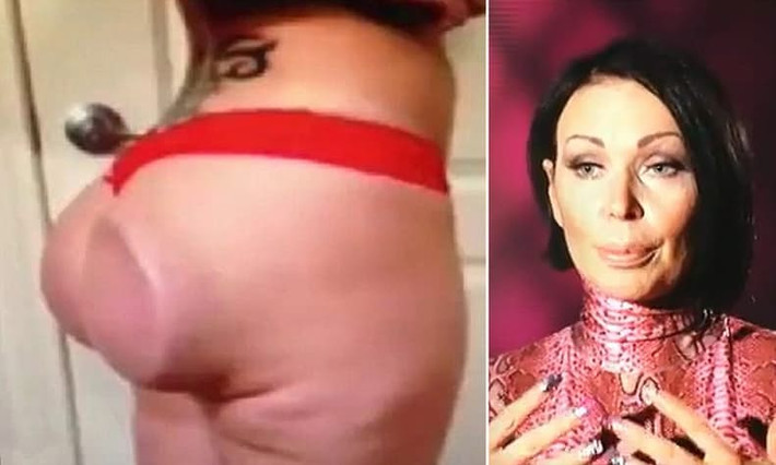 Là một vũ công thoát y tại Las Vegas muốn có vòng 3 ngọt ngào hơn, cô Talley không bao giờ tưởng tượng ra vòng 3 của mình sau thẩm mỹ hỏng lại phẳng dẹt và cứng đơ như một chiếc đĩa thế này. Từng được bác sĩ khuyên không nên phẫu thuật vì vết thương từ lần phẫu thuật trước chưa hồi phục nhưng cô Talley nhất quyết không nghe và hậu quả là vòng 3 của cô bị hư hỏng nghiêm trọng. (Ảnh: Talko)