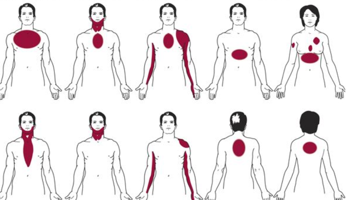 Đây còn được gọi là “thuyết hội tụ” tức dây thần kinh từ nhiều vùng cơ thể hội tụ hết về dây thần kinh cột sống có vai trò giống như một cao tốc thông tin đưa mọi thứ đến não. Trong quá trình này việc thông tin chồng chéo và lẫn lộn thông tin là điều không tránh khỏi.
