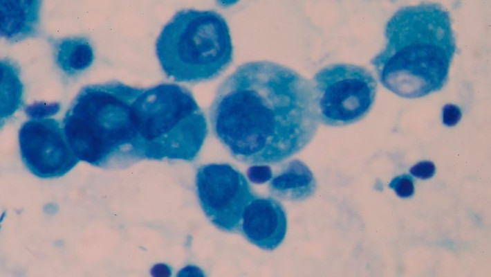 Mới đây Mỹ đã đưa thêm 7 tác nhân mới, trong đó có HIV và một chất hòa tan công nghiệp, vào danh sách những chất gây ung thư.