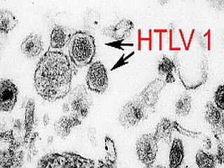 Virus HTLV gây u lympho ở tế bào T: Là loại virus bị nhiễm khi tiếp xúc với các tế bào sinh học hoặc tế bào bị nhiễm virus như khi cho con bú, dùng chung kim tiêm hoặc xy lanh và cả quan hệ tình dục không an toàn.