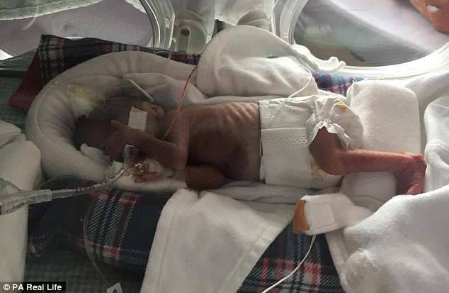Mặc dù vậy vẫn khó có thể đoán trước được tương lai sức khỏe của bé vì còn quá sớm để nói về ảnh hưởng của đẻ non về lâu dài.