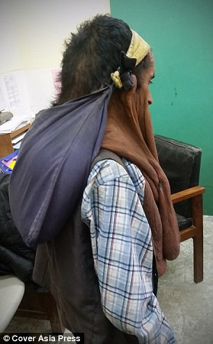 Ông Krishna Krishna Prasad Bhattarai người Nepal năm nay đã 60 tuổi mọc u trên mặt từ khi còn nhỏ. Trong suốt 47 năm khối u cứ thế tăng kích thước không ngừng khiến khuôn mặt ông bị biến dạng.