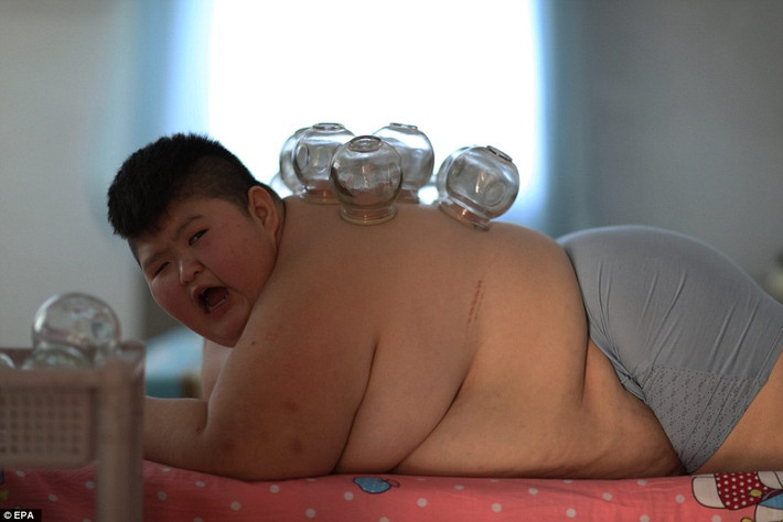 Một cậu bé mới 11 tuổi nhưng nặng tới 146kg đang được điều trị giảm cân bằng một số phương pháp y học cổ truyền Trung Quốc, trong đó có một phương pháp rất nguy hiểm và đáng sợ là dùng lửa đốt mỡ bụng. Cậu bé tên Li Hang này mắc hội chứng Prader-Willi, một rối loạn về gien hiếm gặp gây ám ảnh với ăn uống, khó tiếp thu và phát triển bất thường.