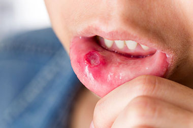 Các vết loét lâu lành: Một vết thương hở nào đó trên da miệng là một trong những dấu hiệu phổ biến nhất của bệnh ung thư khoang miệng và những vết loét này không phải lúc nào cũng đau. (Ảnh: Bitedental)