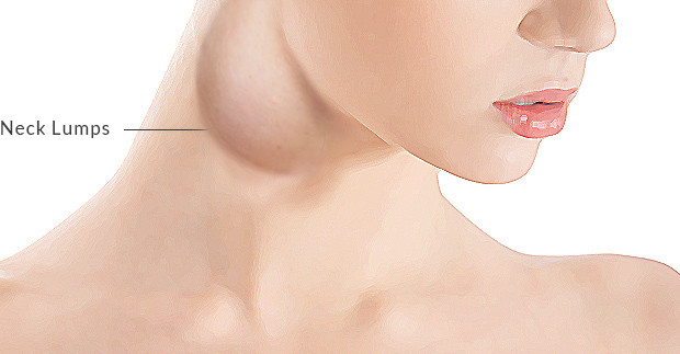 Cũng như các bệnh ung thư khác, nếu cổ bỗng nhiên bị sưng u thì đó cũng là dấu hiệu có một khối u nào đó. (Ảnh: Hitchcock)