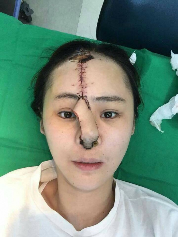 Sau vài ngày vết mổ đã bớt sưng và miếng da cấy vào đã được khâu đính vào đầu mũi. Nhìn những ảnh này, những người có ý định phẫu thuật thẩm mỹ mũi hẳn cũng phải dè chừng. (Nguồn ảnh: The Coverage)
