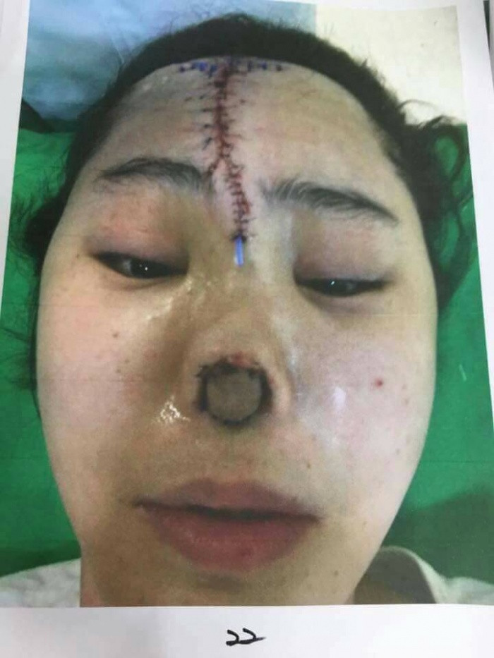 Nhìn bề ngoài thì nhẹ nhất nạn nhân hỏng mũi này đã phải mổ một vết dài trên trán để đặt một chiếc ống gì đó có đầu thông ra ngoài, trông giống như là hút dịch bên trong ra ngoài.