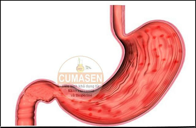 Khi thấy phân chuyển sang màu đen và có mùi rất khó chịu, cô Christine so sánh những dấu hiệu của mình với những dấu hiệu trên một trang web điện tử chuyên về sức khỏe NHS thì thấy có vẻ như mình đã bị chảy máu dạ dày.