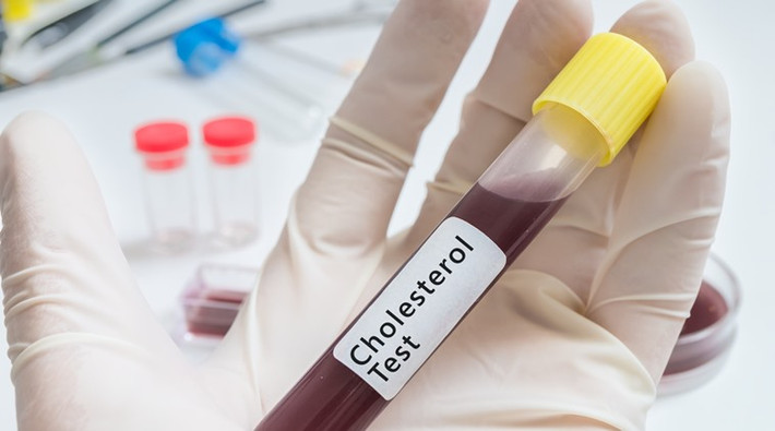 Mọi người thường nghĩ rằng trước khi xét nghiệm cholesterol thì cần phải nhịn ăn để kết quả chính xác hơn vì mỡ từ thực phẩm sẽ ảnh hưởng đến các chỉ số xét nghiệm. Tuy nhiên, một nghiên cứu mới đã phát hiện ra ăn trước khi xét nghiệm cholesterol không ảnh hưởng đến độ chính xác của kết quả xét nghiệm.