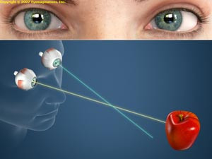 Đối với trẻ em, các yếu tố nguy cơ của bệnh nhược thị là: sinh non, sinh nhỏ con nhẹ cân, tiền sử gia đình có người bị nhược thị, bất thường trong sự phát triển.