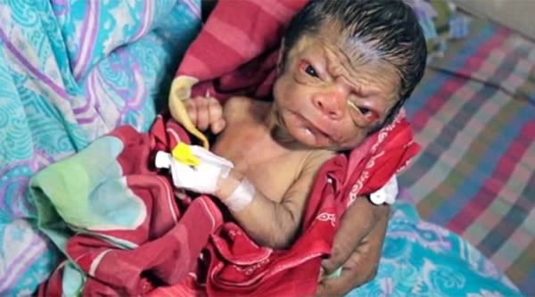 Một em bé sơ sinh được gọi là Benjamin Button của Bangladesh khi mới đẻ mà trán đầy nếp nhăn, mắt hõm sâu, da nhăn nheo trông giống như một ông già vì mắc bệnh lão hóa sớm. Em bé này khiến bất cứ ai cũng phải tò mò đến xem nhưng bố mẹ của bé thì lại không hề cảm thấy căng thẳng. Ước tính cứ 8 triệu ca sinh thì có 1 trường hợp bị lão hóa sớm như thế này.