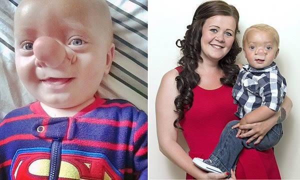 Một em bé ở xứ Wales đã được gọi là Pinocchio giữa đời thực vì một căn bệnh hiếm gặp khiến cậu bé có chiếc mũi dài như nhân vật trong phim. Đây là bệnh thoát vị não, một dị tật bẩm sinh khiến não phát triển xuyên qua sọ và chui xuống mũi. Mới 21 tháng tuổi nhưng bé Ollie Trezise đã phải mổ vài lần thì mới thở được.