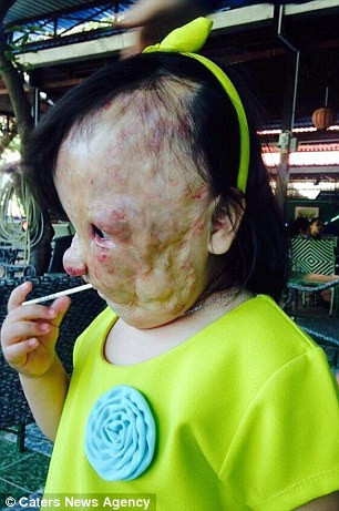 Với số tiền từ thiện nhận được từ Hội từ thiện trẻ em Mending Kids International, bà Maxey đã đặt vé máy bay cho bé Nguyệt và mẹ bay tới Marid (Tây Ban Nha) gặp một bác sĩ phẫu thuật nổi tiếng Beatriz Berenguer, người đã đồng ý phẫu thuật miễn phí cho Nguyệt. Bản thân bà Maxey cũng tự mình bay tới Tây Ban Nha để đón hai mẹ con bé Nguyệt ngay tại sân bay.