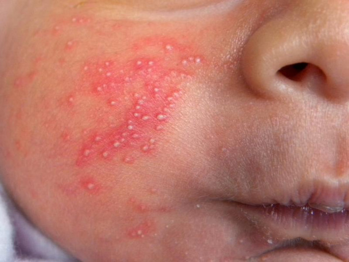 Nếu bị lở miệng hoặc bị ốm vì virus herpes thì không nên hôn em bé. Nếu đang cho con bú và bị lở miệng cần rửa sạch tay trước khi cho con bú cũng như tìm cách che kín chỗ lở lại để tay không chạm vào.