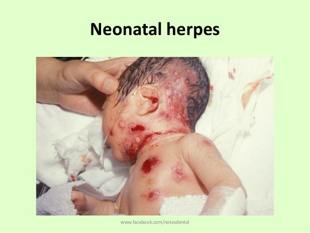 Trẻ sơ sinh có nguy cơ bị nhiễm virus herpes nếu người mẹ bị herpes sinh dục lần đầu tiên trong vòng 6 tuần cuối của thai kỳ và sinh qua ngả âm đạo. Nguy cơ này sẽ giảm đi nếu người mẹ bị herpes một khoảng thời gian trước khi mang thai. Virus herpes cũng có thể lây lan khi một người bị bệnh lở miệng hôn trẻ sơ sinh hoặc người mẹ cho con bú khi bị herpes ở vùng ngực.