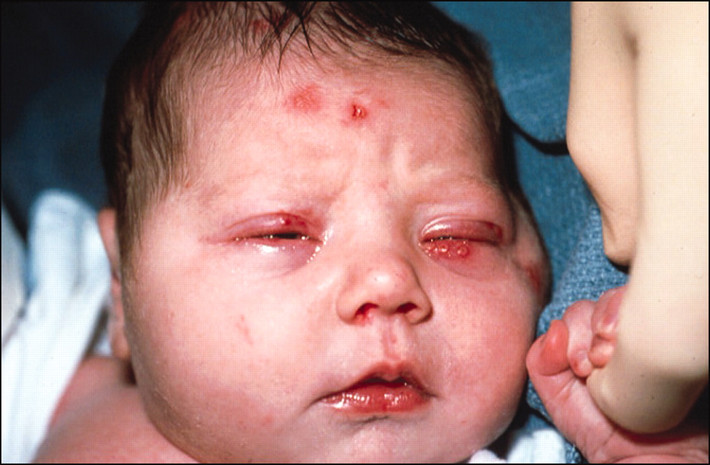 Các dấu hiệu của herpes sơ sinh là: mệt mỏi, không chịu ăn, người bệu không chắc, sốt, khóc thét, khó thở hoặc thở gằn, lưỡi và da xanh, nổi ban…