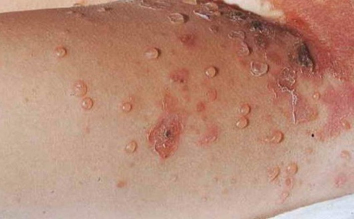 Cách tốt nhất để xác định em bé có bị herpes hay không là đưa bé đi khám bác sĩ. Phụ nữ đang mang thai bị herpes sinh dục cần thông báo cho bác sĩ biết để được cho uống thuốc hoặc lựa chọn hình thức sinh nở phù hợp.