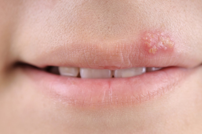 Herpes là một bệnh viêm phổ biến do virus HSV gây đau và phồng rộp ở cơ quan sinh dục ngoài. Bệnh có thể lây qua đường tình dục. Đây là một bệnh mãn tính lâu khỏi và có thể tái phát. Tỉ lệ phát bệnh là khoảng 4-5 lần trong 2 năm đầu và sau đó ít dần đi.
