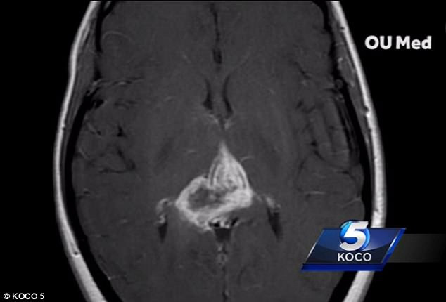 Sau kiểm tra phát hiện cô bị ung thư não Glioblastoma, một khối u não ác tính nằm gần tuyến tùng. Bác sĩ cho biết cô chỉ còn sống được 15 tháng.