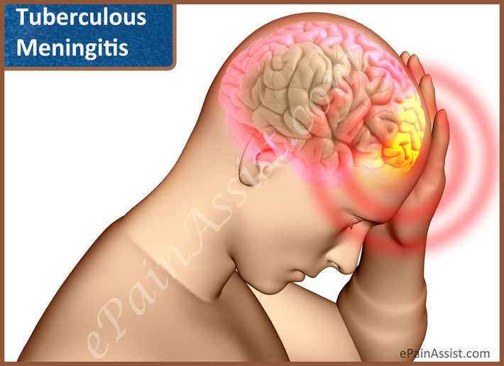Các triệu chứng của bệnh viêm màng não gồm sốt, đau đầu, ốm nhưng nhanh chóng chuyển biến xấu. Nếu không phát hiện kịp thời để bệnh sang giai đoạn sau, viêm màng não có thể gây mơ hồ, mất định hướng, hôn mê. Điều nguy hiểm là những triệu chứng này rất dễ bị nhầm lẫn với say rượu.