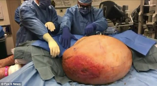 Trong ca phẫu thuật kéo dài 5 giờ, các bác sĩ đã cẩn thận cắt bỏ khối u khổng lồ nặng 50kg cùng với khoảng 15kg da thừa cho bệnh nhân.