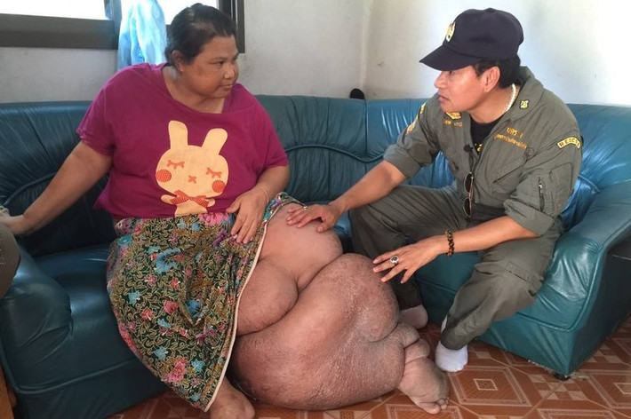 Cách đây 2 năm, một bên chân của cô Juan Suwanchatree, 44 tuổi, bắt đầu sưng to lên vì bị nhiễm trùng giun chỉ bạch huyết. Ban đầu chỉ là một cục u nhỏ nhưng sau đó cứ lớn lần thành bệnh phù chân voi.