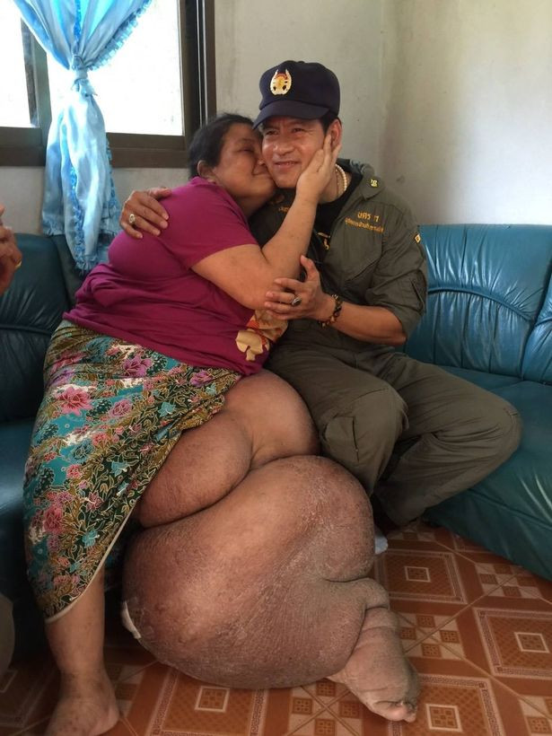 Mặc dù đã được bác sĩ cho thuốc và dùng cả thuốc nam thuốc bắc nhưng đều không tác dụng. Khả năng là do sau khi bị nhiễm trùng thì chân cô tích nước nên càng ngày càng to lên.