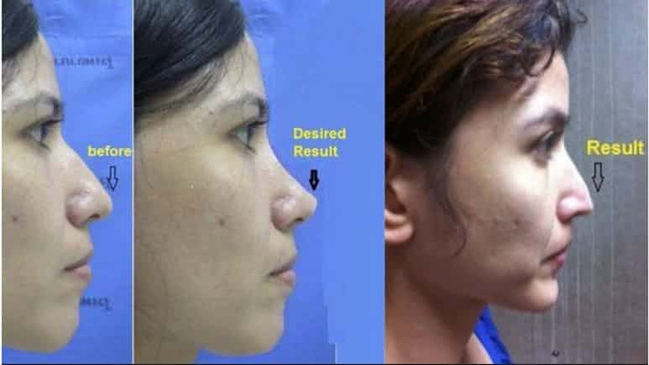 Năm 2010, bệnh nhân Helena Grace người Thái Lan quyết định phẫu thuật nâng mũi sau khi đã suy nghĩ kỹ càng. Cô đến gặp bác sĩ tư vấn và quyết định phẫu thuật luôn. Sau đó, cô cảm thấy có điều gì đó không ổn nhưng bác sĩ khẳng định không sao. Khi tháo băng ra, ngoài chiếc mũi với hình dáng không như cô mong đợi thì cô còn không thở được bằng mũi. Bác sĩ thừa nhận phẫu thuật thẩm mỹ hỏng và cho biết nếu chỉnh sửa lại thì còn tốn kém hơn nữa. Cô Helena quyết định kiện ra tòa nhưng thua kiện.
