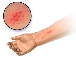Nếu bị dị ứng, formaldehyde có thể gây viêm da và bỏng hóa chất. Nghiêm trọng hơn, formaldehyde này có thể ảnh hưởng đến nhịp tim và gây co giật. Hóa chất độc hại trong sơn móng tay này còn liên quan đến ung thư.