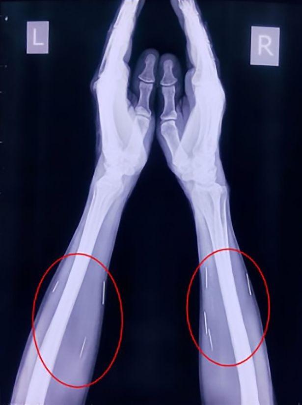 Trong một lần phát hiện mình bị đinh đâm vào chân, ông Meena, một nhân viên ngành đường sắt, đã đến bệnh viện đường sắt tại Mumbai, Ấn Độ. Nhưng khi đến bệnh viện Jagjivan Ram vào ngày 21/4, ông mới biết vấn đề đáng lo ngại hơn rất nhiều.