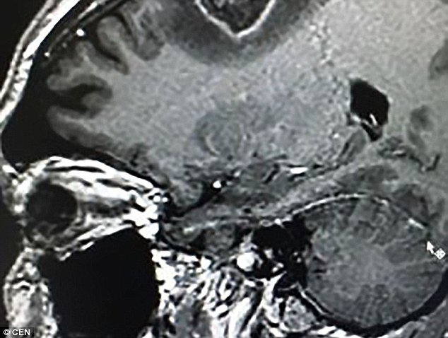 Bệnh nhân Rolden Batista, 40 tuổi, được các bác sĩ đưa cho một cây đàn guitar vào giữa ca mổ phức tạp để loại bỏ khối u hình trái tim trong đầu. Trước sự ngạc nhiên của các bác sĩ, bệnh nhân này đã vừa đàn vừa hát một bài hát truyền thống của Brazil.