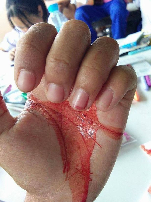 Cứ mỗi khi bị đau đầu Phaka (tên thường gọi là Preo) đổ mồ hôi ra máu . Ngoài mắt, mũi, tai, Preo còn ra máu từ các vùng da khác (qua các nang lông), chẳng hạn như bàn tay.
