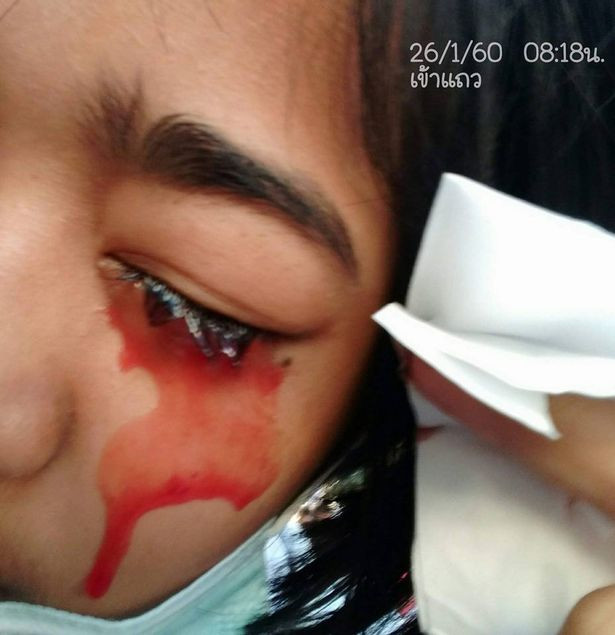 Chứng mồ hôi máu là hiện tượng các mao mạch bị dò vào tuyến mồ hôi nên trông như đổ mồ hôi ra máu. Ước tính cứ 10 triệu người thì có 1 người mắc phải.