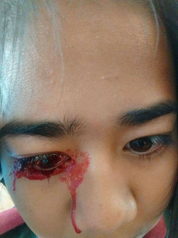 Mặc dù căn bệnh trông đáng sợ nhưng bé cô bé chẳng hề cảm thấy đau đớn. Tuy đã được điều trị tại bệnh viện Kon Khaen nhưng không có gì tiến triển.