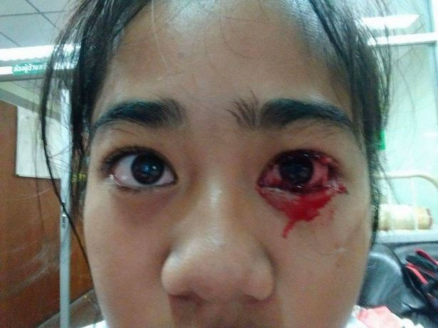 Chứng bệnh khóc ra máu này bắt đầu xảy ra với bé Phakamad Sangchai, 14 tuổi, mới cách đây 6 tháng nhưng càng ngày càng nặng khiến cô bé không dám ra ngoài đường vì sợ chảy máu.