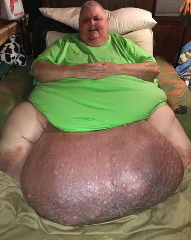 Một người đàn ông với khối u khổng lồ nặng gần 60kg trong bụng đã nhiều năm chỉ quanh quẩn xung quanh một chiếc ghế không đi lại được vì bác sĩ bảo đó chỉ là mỡ thừa.