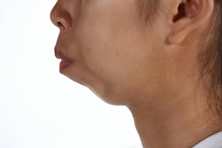 Wijitpraphorn Punbu (tên thường gọi là Fon), 19 tuổi, đã nhiều năm bị trêu chọc một cách tàn nhẫn vì bẩm sinh răng hô và hàm bị sụp.