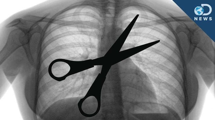Quên đồ trong người bệnh nhân sau khi mổ: Sai sót này xảy ra với tỉ lệ 1/1.000-1.500. Vật hay bị bỏ quên trong bụng nhất là bông y tế, tiếp theo là kim, kéo, banh và kẹp. Hậu quả là bệnh nhân không chỉ đau đớn phải mổ lại mà đôi khi còn khiến người bệnh thiệt mạng.