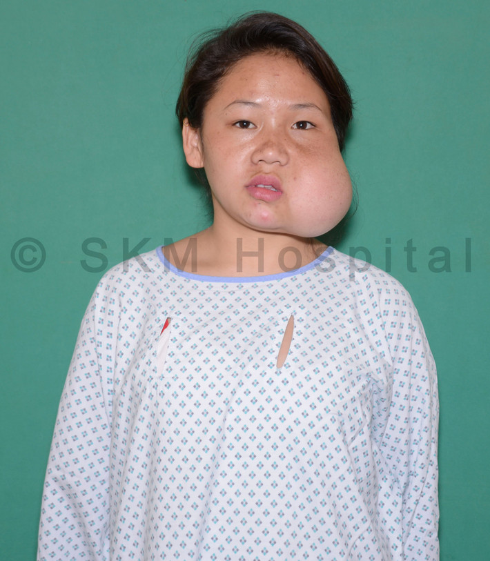 Từng đấy năm sống trong đau khổ cả về thể chất và tinh thần, Bina không dám soi gương và thường cảm thấy ghen tị với các bạn bè cùng lứa. Mỗi khi ra đường để tránh bị người khác soi mói, cô phải lấy khăn che mặt.
