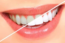 Tác hại của việc lạm dụng tẩy trắng răng tại nhà