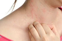 Mẹo giảm khó chịu do dị ứng thời tiết